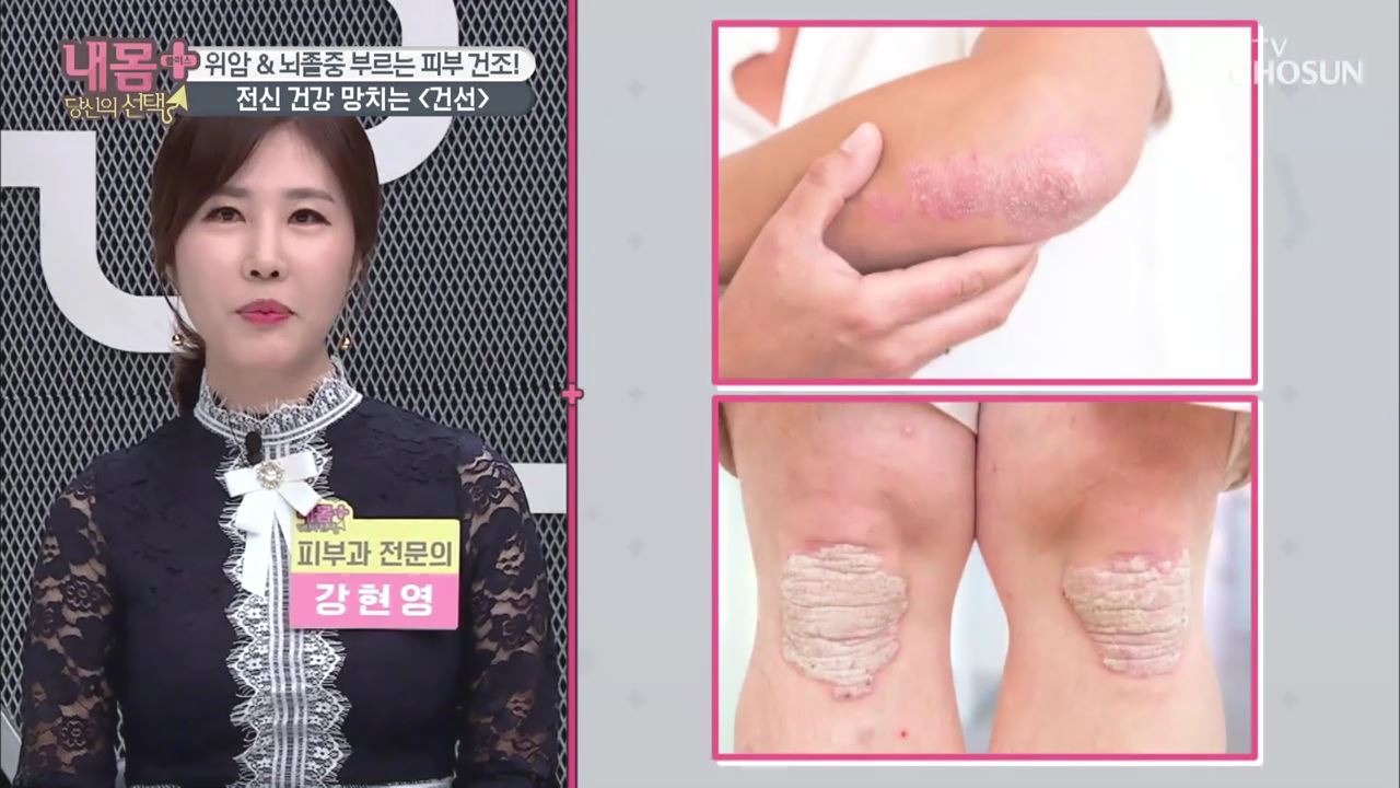 내 몸 플러스 170회