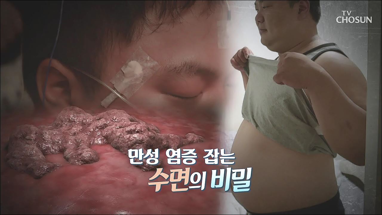 건강다큐 102회 - 만성 염증 잡는 수면의 비밀