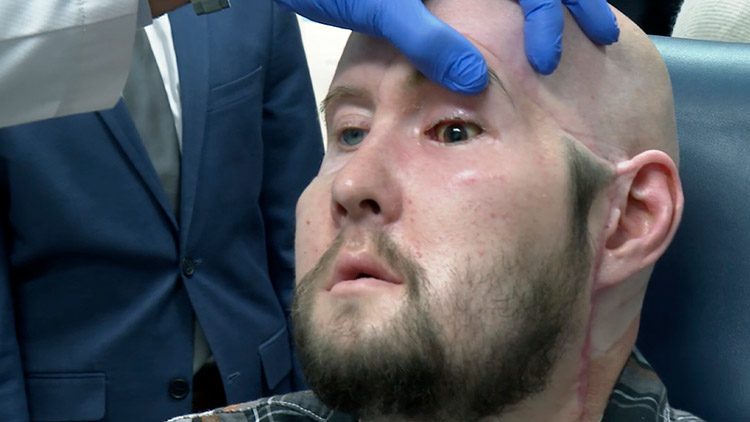 美의료진, 감전으로 눈 잃은 40대 남성에 세계 최초 '안구 이식' 수술
