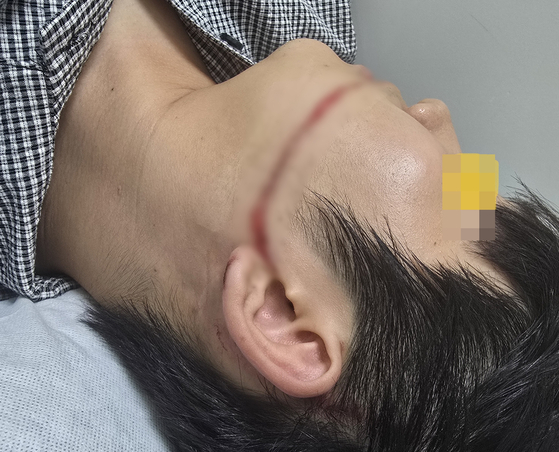 축제 공연중 워터건에 맞아 얼굴을 크게 다친 A씨.