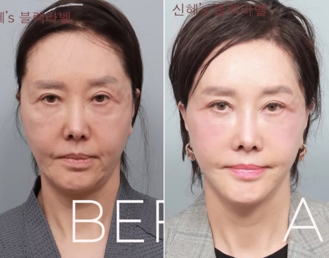 '62세' 유혜리, 안면거상 후 확 달라진 외모